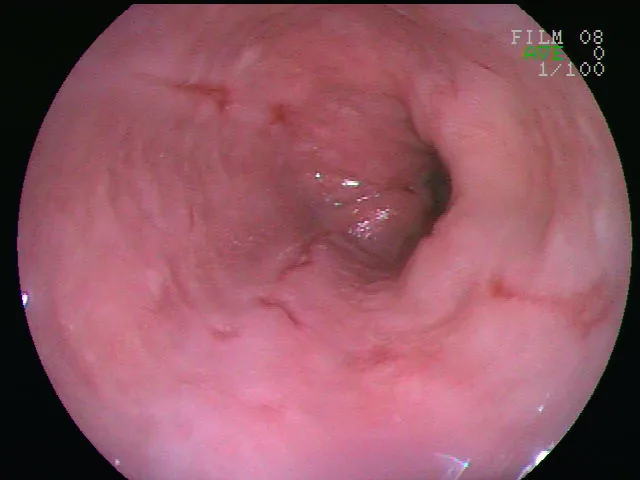 Gastro-esophageal reflux disease (GERD, heartburn) – Endoscopy in severe reflux esophagitis: elongated erosions and ulcers of the distal esophageal mucosa with early narrowing
