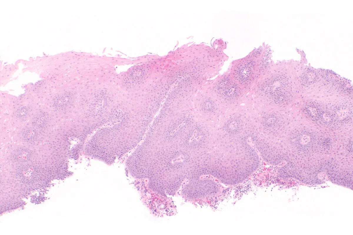 Gastro-esophageal reflux disease (GERD, heartburn) – Histology (H&E) of esophageal mucosa in reflux disease: basal cell hyperplasia and elongated papillae in the squamous epithelium