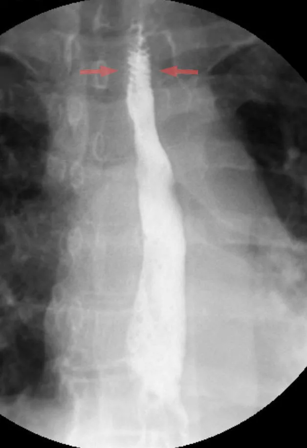 Gastro-esophageal reflux disease (GERD, heartburn) – X-ray: Barium swallow: fine transverse mucosal folds of the esophagus (arrows) in reflux, so-called 'feline esophagus'