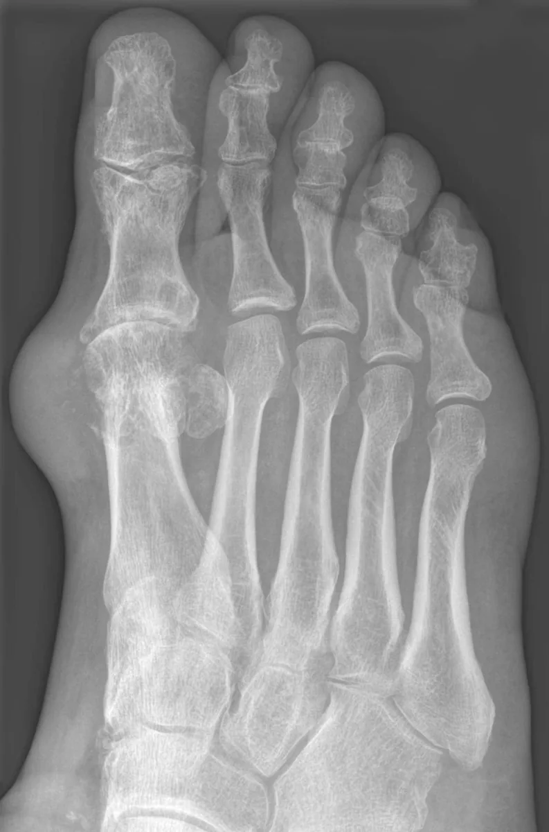 Gout – Oblique forefoot X-ray: punched-out erosions at the first MTP joint with overhanging edges and soft-tissue swelling (tophus)