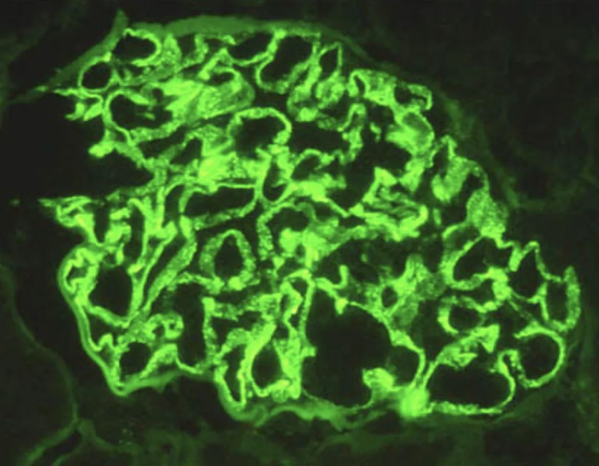 Goodpasture syndrome (anti-GBM disease) – Immunofluorescence in anti-GBM disease: linear IgG deposition along the glomerular capillary loops