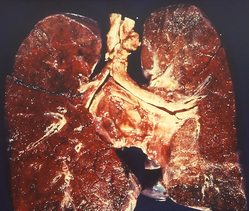 Goodpasture syndrome (anti-GBM disease) – gross specimen: Gross lung specimen in Goodpasture syndrome: diffuse alveolar hemorrhage with dark red lung tissue