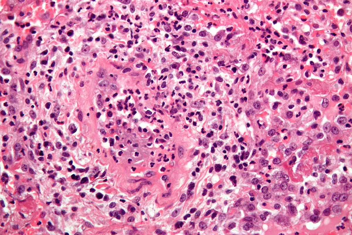 Granulomatosis with polyangiitis (GPA) – Lung histology (H&E): necrotising granulomatous inflammation with vessel wall involvement and a mixed infiltrate