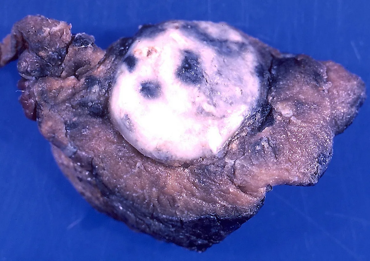 Granulomatosis with polyangiitis (GPA) – gross specimen: Lung specimen: well-demarcated whitish nodule with central necrosis