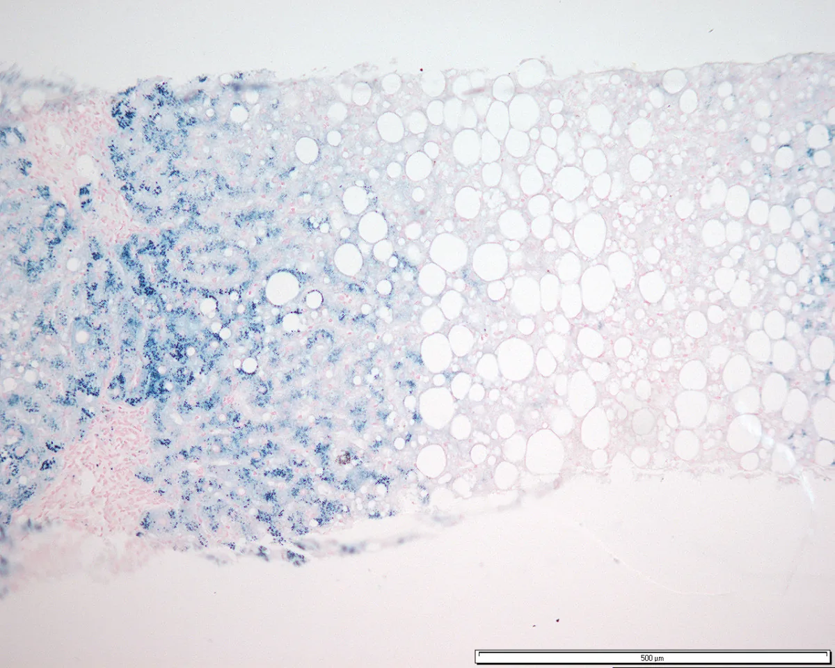 Hemochromatosis – histology: Liver biopsy (Perls' Prussian blue stain): blue-stained iron deposits in hepatocytes with periportal predominance (grade 3), with coexisting steatosis