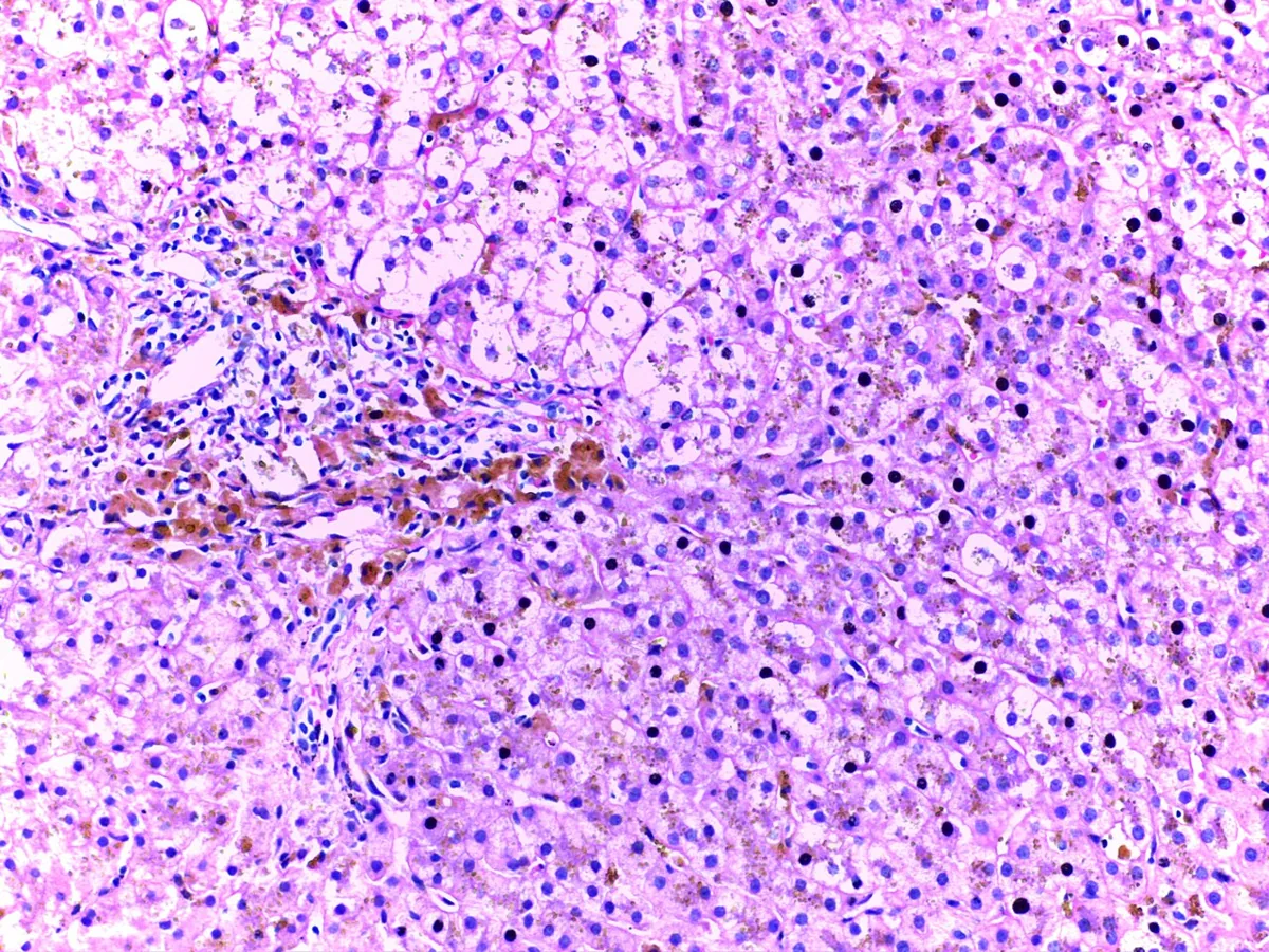 Hemochromatosis – Histology (H&E) in hemochromatosis: brown-yellow hemosiderin pigment in hepatocytes and the portal tract
