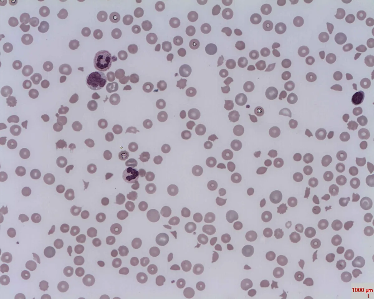 Hämolytische Anämien – Blutausstrich bei mikroangiopathischer hämolytischer Anämie: Fragmentozyten (Schistozyten) und Sphärozyten