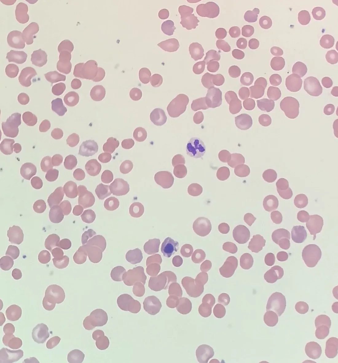Hämolytische Anämien – Blutausstrich bei hämolytischer Anämie: kleine dichte Sphärozyten neben großen, bläulichen polychromatischen Erythrozyten (Retikulozyten)