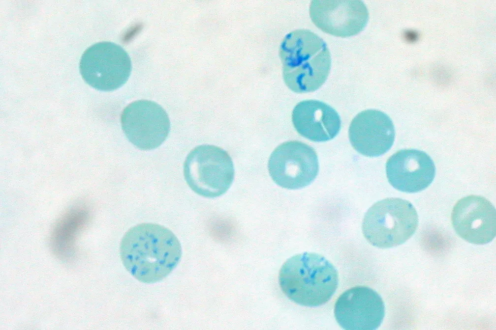 Hämolytische Anämien – Blutausstrich/Zytologie: Supravitalfärbung: Retikulozyten mit blau angefärbtem, netzartigem RNA-Rest (Retikulozytose als Zeichen gesteigerter Blutbildung)