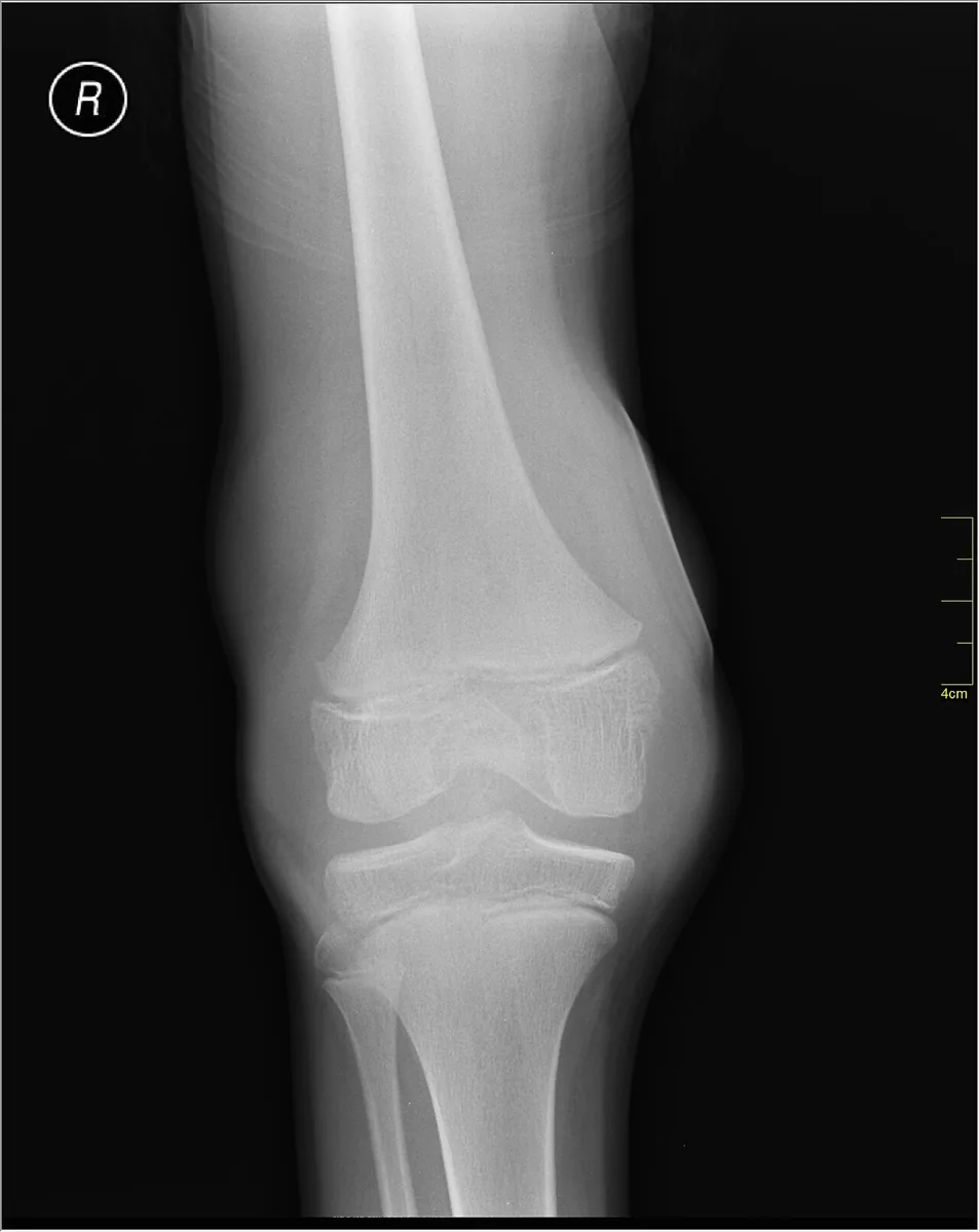 Hemophilia – Knee X-ray: marked joint and soft-tissue swelling due to bleeding into the knee joint (hemarthrosis)