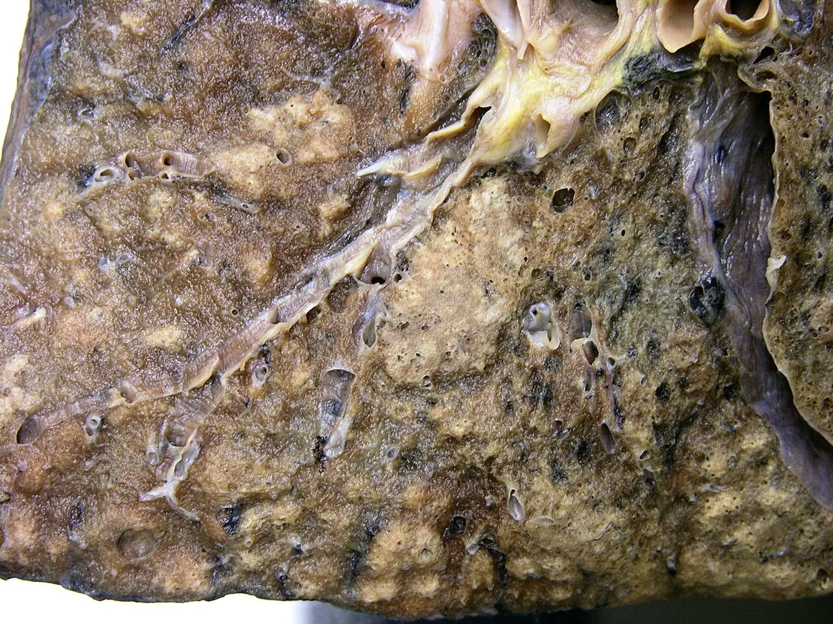 Hospital-acquired pneumonia (HAP/VAP) – Gross specimen: bronchopneumonia with many small, focal, partly confluent yellowish consolidations around the bronchi