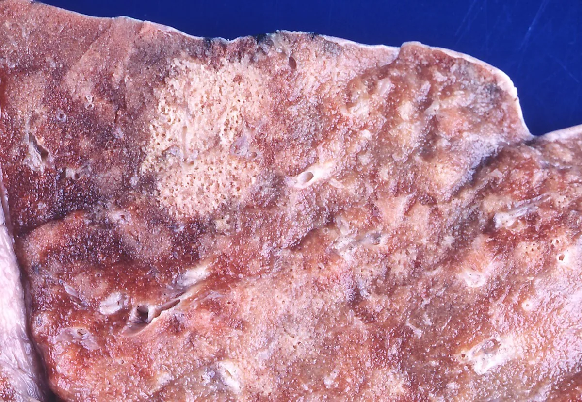 Hospital-acquired pneumonia (HAP/VAP) – Gross specimen: Pseudomonas pneumonia (a typical nosocomial pathogen) with patchy pale consolidated foci in hemorrhagic lung tissue