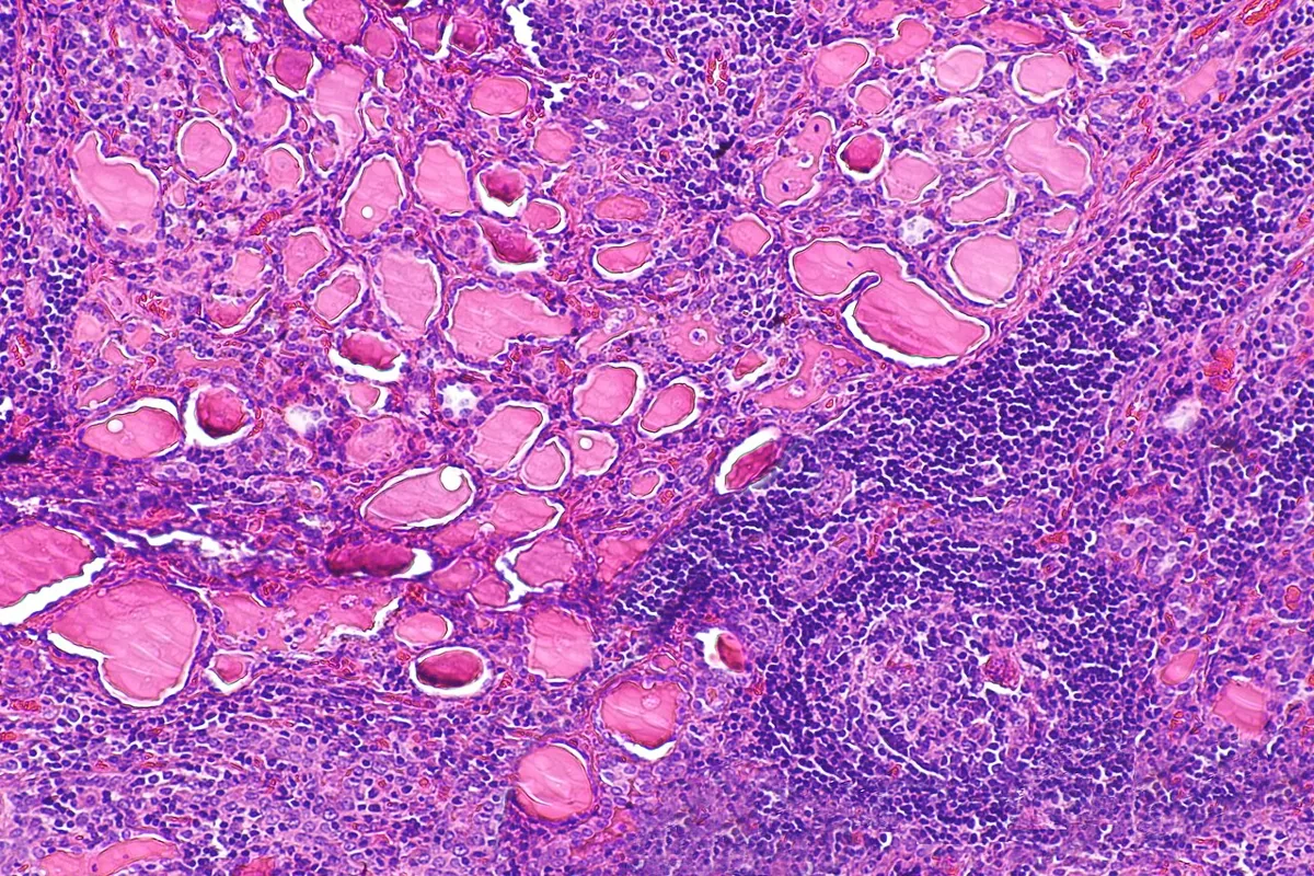 Hashimoto's thyroiditis (underactive thyroid) – Histology of Hashimoto's thyroiditis (H&E): dense lymphocytic infiltrate with a germinal center next to small thyroid follicles
