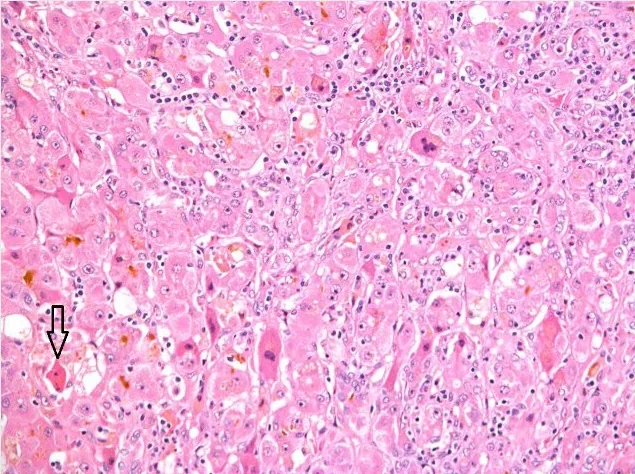 Hepatitis A – Histology (H&E) of acute hepatitis: lobular disarray, lymphocytic inflammation, an acidophil body (arrow) and bilirubinostasis – the pattern of acute viral hepatitis