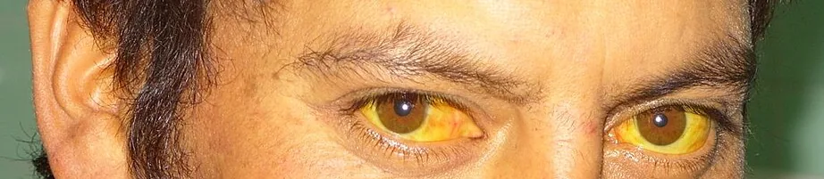 Hepatitis A (Leberentzündung) – klinisches Foto: Ausgeprägter Sklerenikterus (Gelbfärbung der Bindehaut) bei akuter Hepatitis