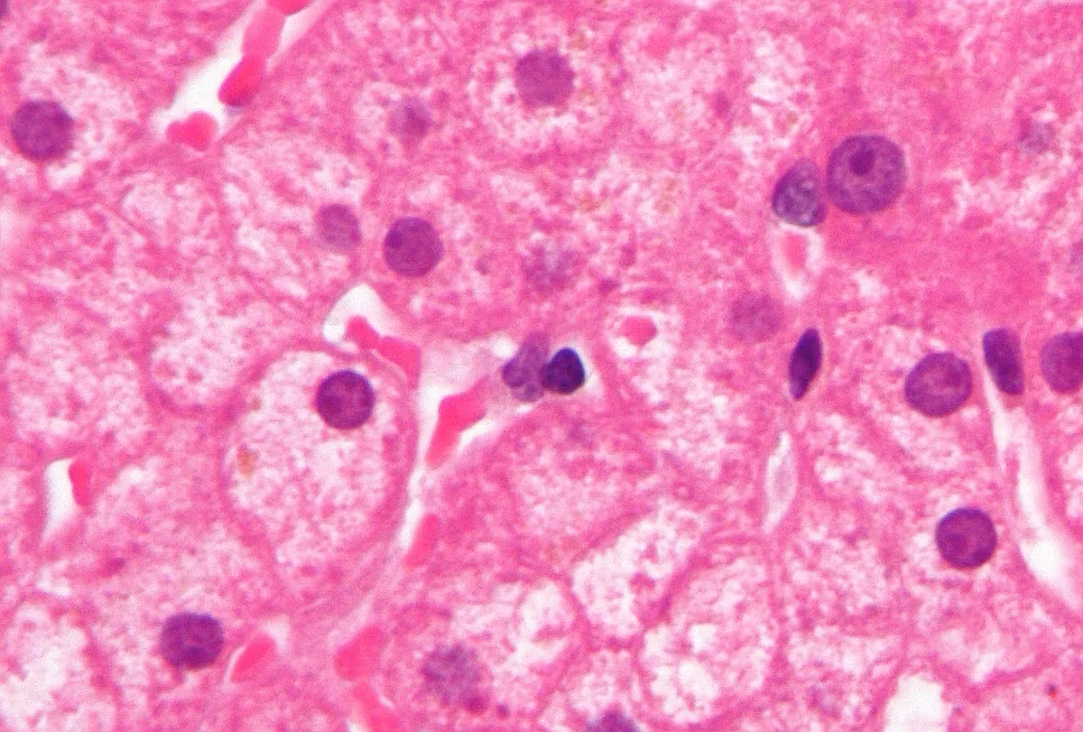 Hepatitis B – Histology (H&E) in chronic hepatitis B: ground-glass hepatocytes with finely granular, pale eosinophilic cytoplasm (HBsAg accumulation)