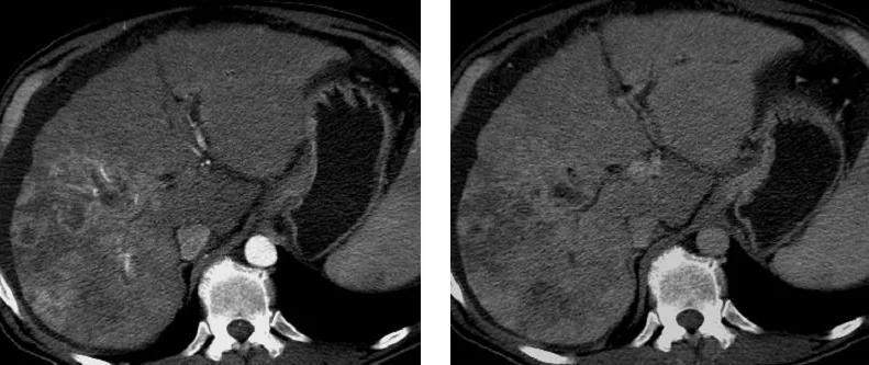 Hepatocellular carcinoma (HCC, liver cancer) – CT in liver cirrhosis: HCC in the right lobe with arterial-phase hyperenhancement (left) and washout in the portal venous phase (right)