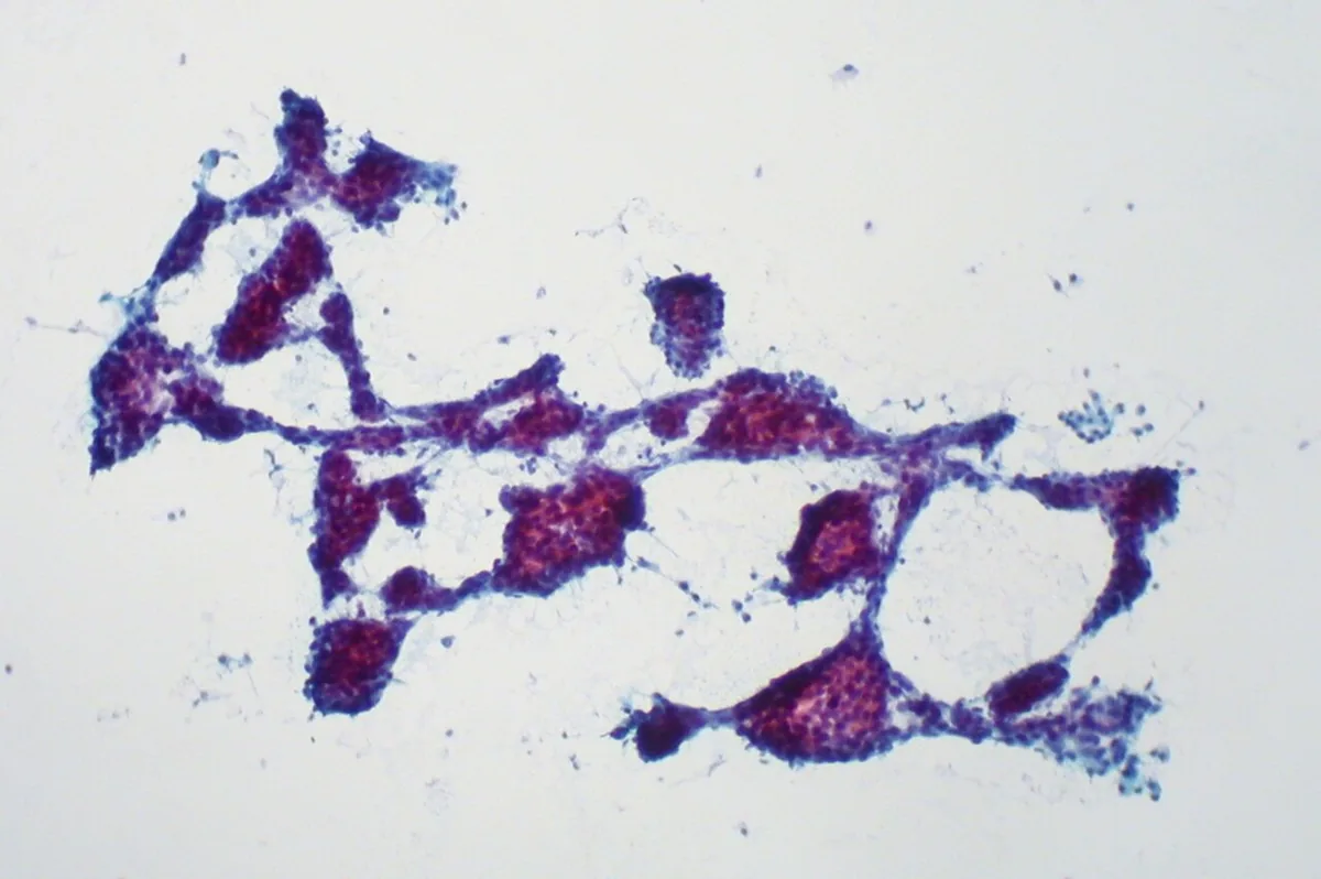 Hepatocellular carcinoma (HCC, liver cancer) – Fine-needle aspirate (cytology): clusters of atypical hepatocytes rimmed by capillary strands – typical of hepatocellular carcinoma