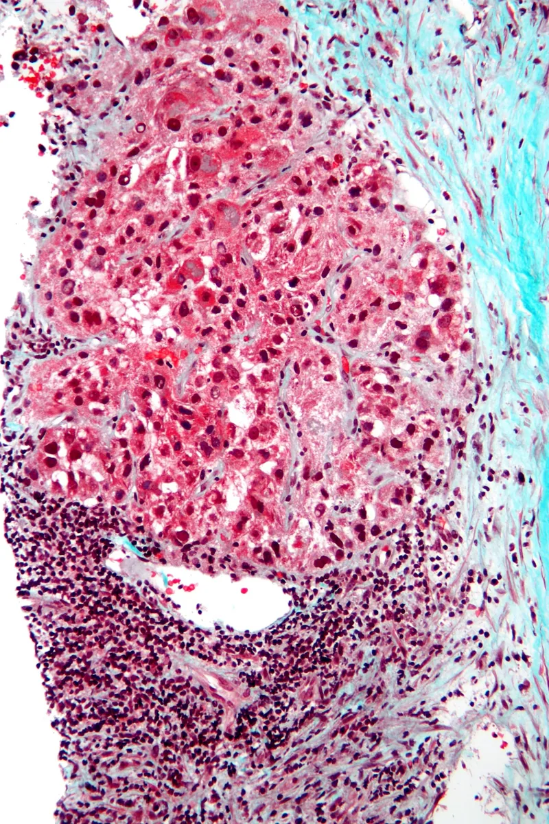 Hepatocellular carcinoma (HCC, liver cancer) – Histology (trichrome stain): hepatocellular carcinoma with atypical, thickened hepatocyte trabeculae next to blue-stained cirrhotic fibrosis