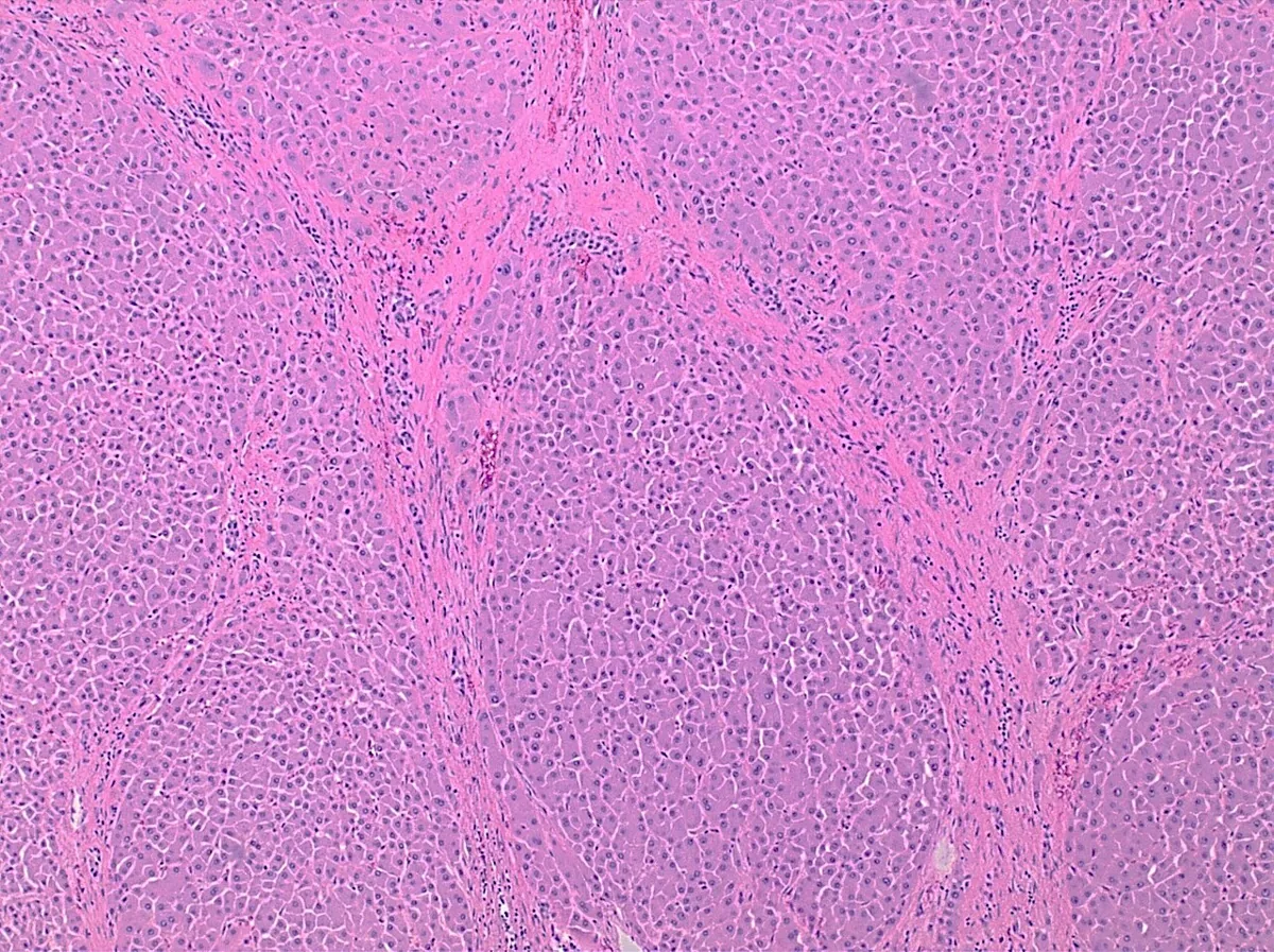Hepatitis C – Histology (H&E) in chronic hepatitis C: fibrous septa between liver lobules with chronic inflammation (advanced fibrosis to cirrhosis)