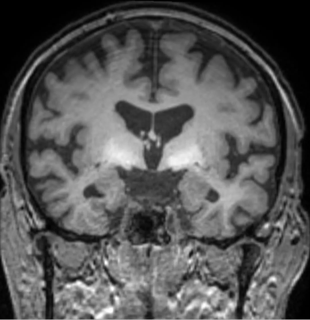 Hepatic encephalopathy – Coronal T1 MRI without contrast in liver cirrhosis: symmetric hyperintensity of the basal ganglia (globus pallidus) – acquired hepatocerebral degeneration