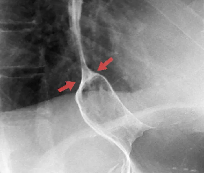 Hiatus hernia – X-ray: Barium swallow: sliding hiatus hernia with the cardia (arrows) above the diaphragm