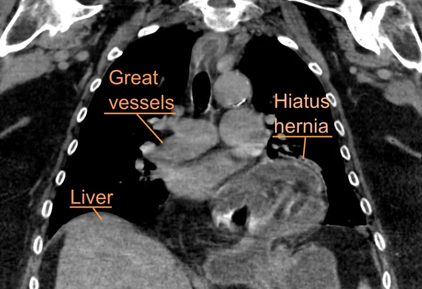 Hiatus hernia – Coronal CT (labelled): part of the stomach above the diaphragm in the lower mediastinum