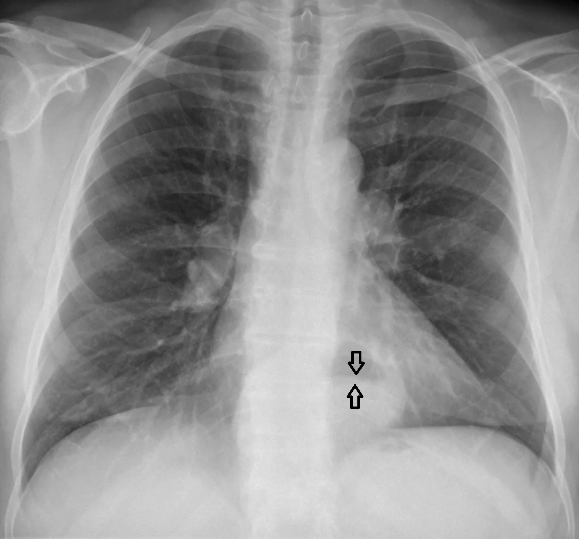 Hiatus hernia – Chest X-ray: retrocardiac air collection with an air-fluid level (arrows) from the herniated part of the stomach