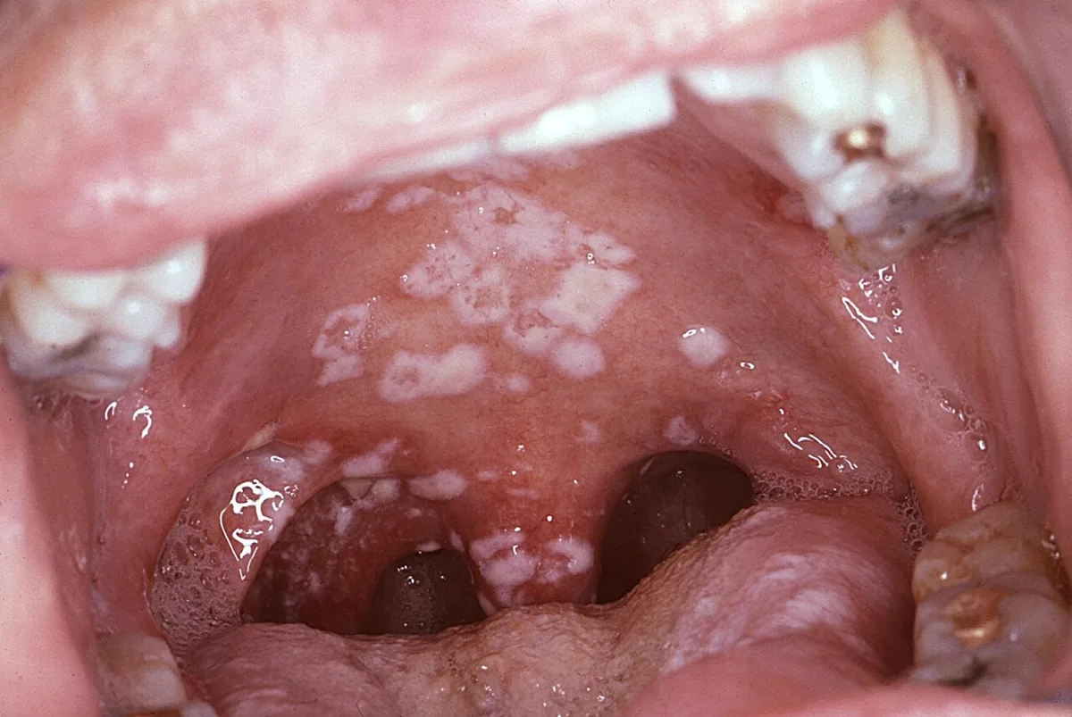 HIV infection and AIDS – mouth – clinical photo: Oral thrush in HIV infection: wipeable white pseudomembranous plaques on the palate and palatal arches