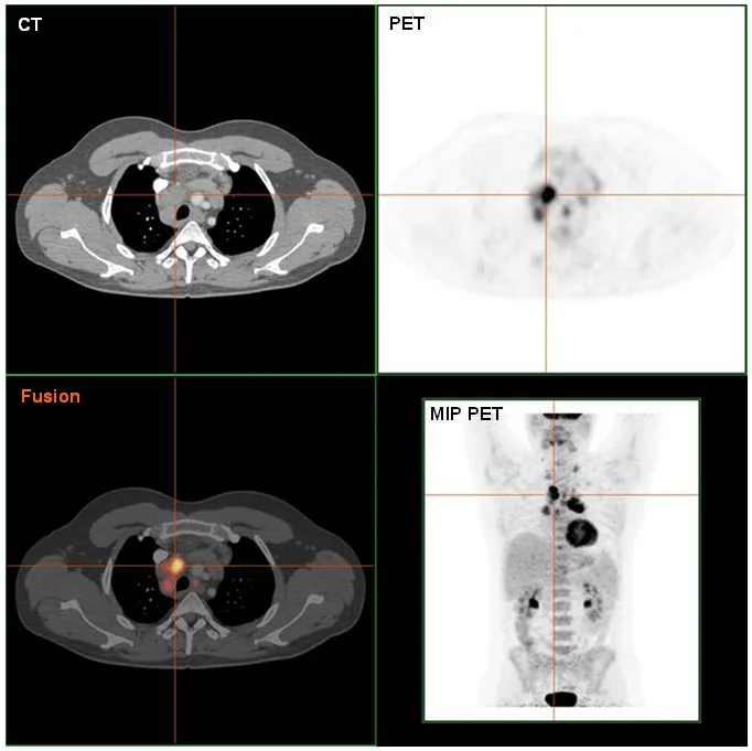 Hodgkin lymphoma – PET-CT in Hodgkin lymphoma: metabolically active (FDG-avid) mediastinal lymph node involvement on CT, PET, fusion and MIP