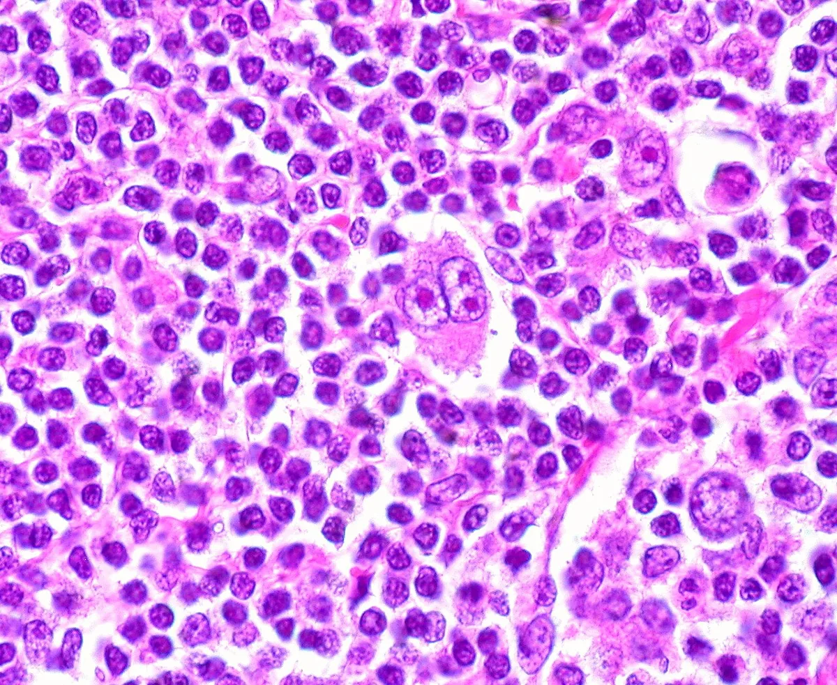 Hodgkin lymphoma – Lymph node histology: large binucleate Reed-Sternberg cell with prominent nucleoli amid small lymphocytes