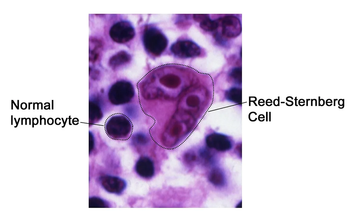 Hodgkin lymphoma – histology: Reed-Sternberg cell (labeled) compared with a normal small lymphocyte