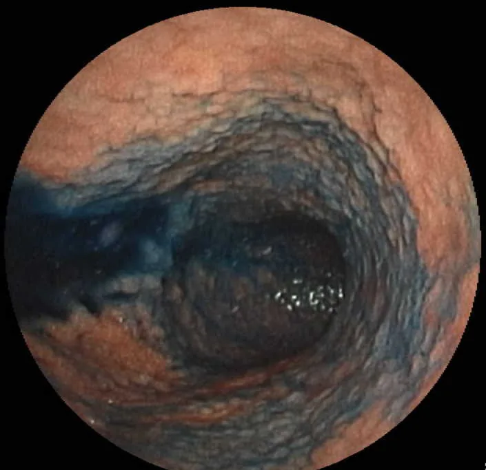 Helicobacter pylori infection – endoscopy: Gastroscopy with indigo carmine staining: finely nodular antral mucosa (nodular gastritis), typical of Helicobacter infection