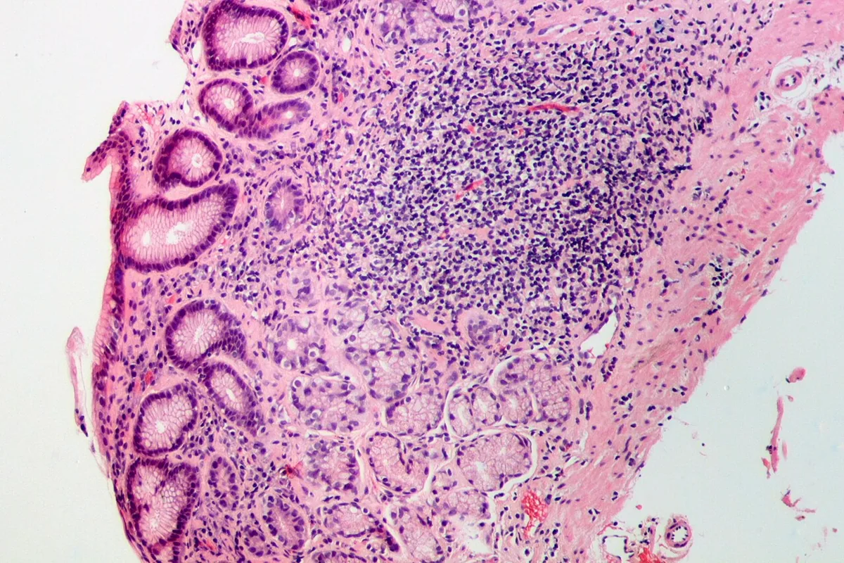 Helicobacter pylori infection – Histology (H&E) of Helicobacter gastritis: dense lymphoplasmacytic infiltrate with a lymphoid follicle in the lamina propria