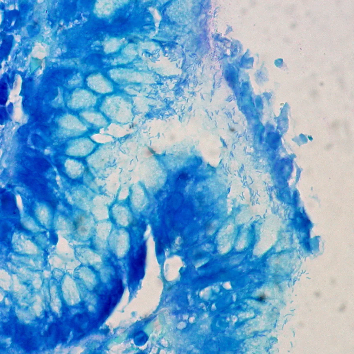 Helicobacter pylori infection – histology: Gastric biopsy (Giemsa stain): numerous fine curved rod-shaped bacteria in the mucus above the surface epithelium