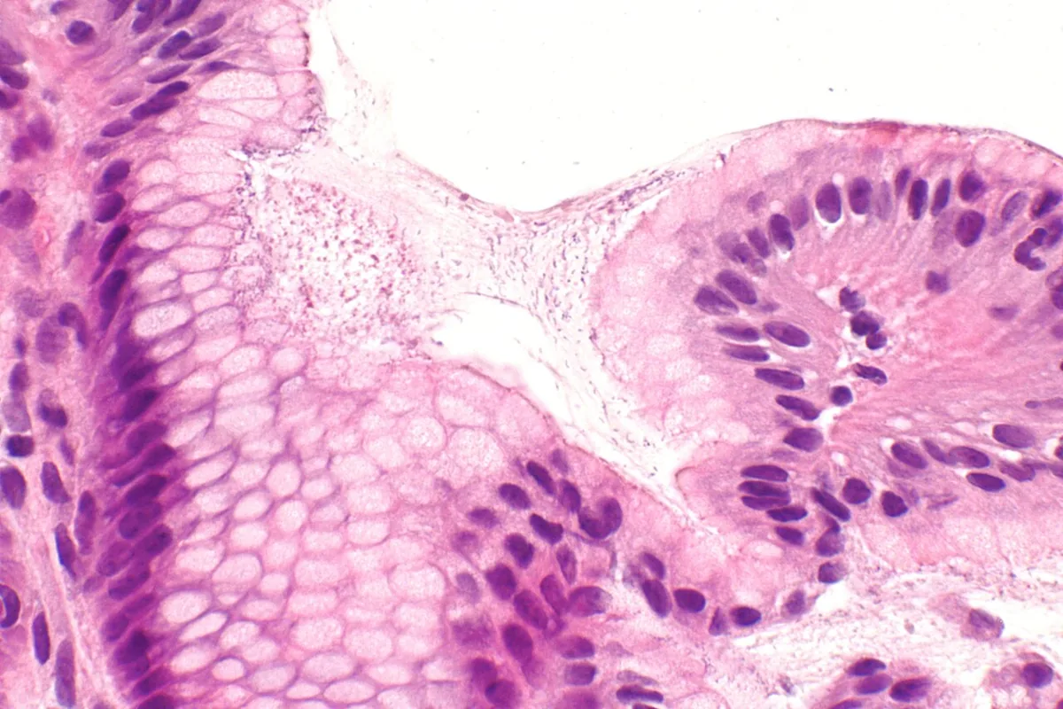 Helicobacter pylori infection – Gastric biopsy (H&E, high power): Helicobacter organizms as fine rods in the mucus on the epithelial surface