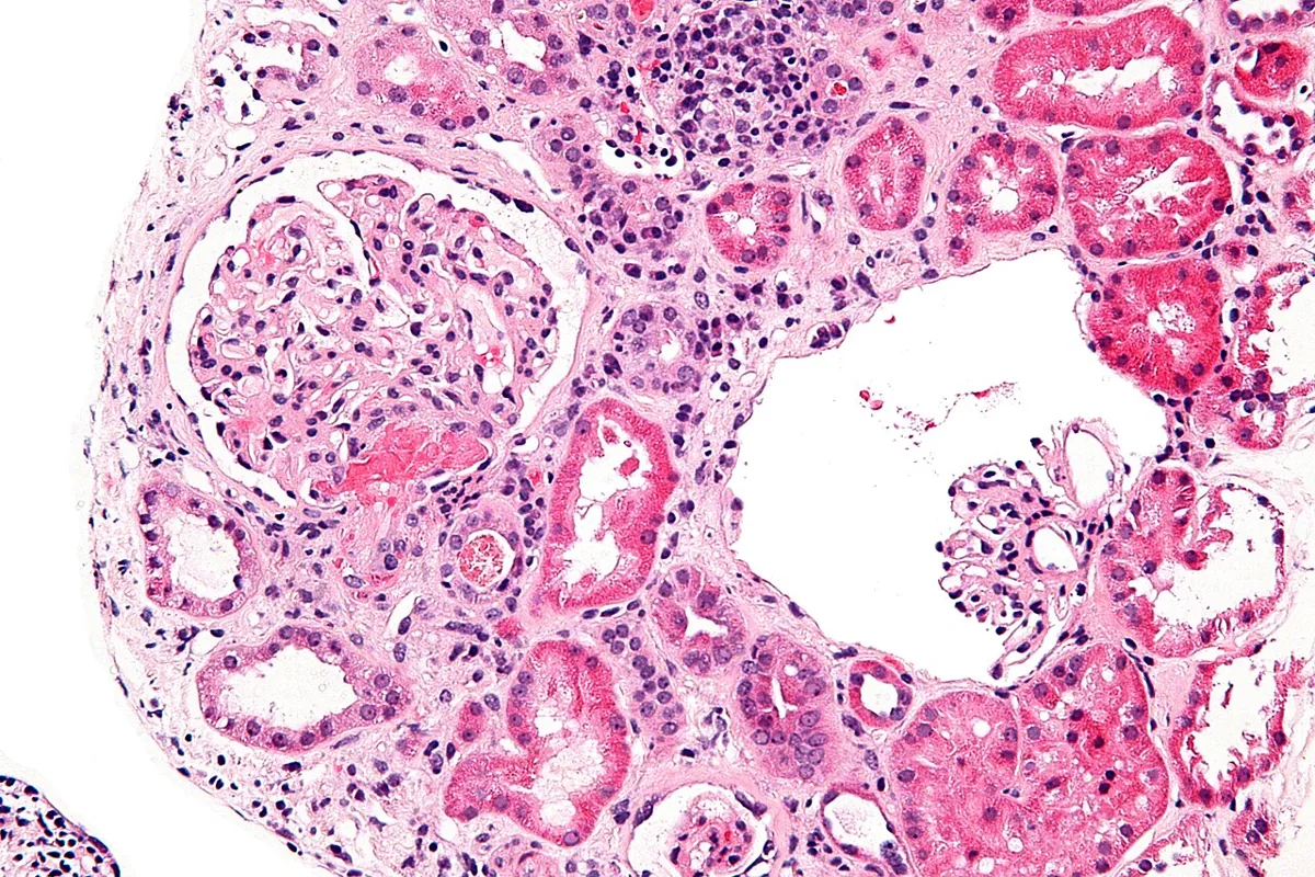 Hemolytic uremic syndrome (HUS) – histology: Kidney biopsy in acute thrombotic microangiopathy: glomerulus with fibrin thrombi and fragmented red cells in the capillaries