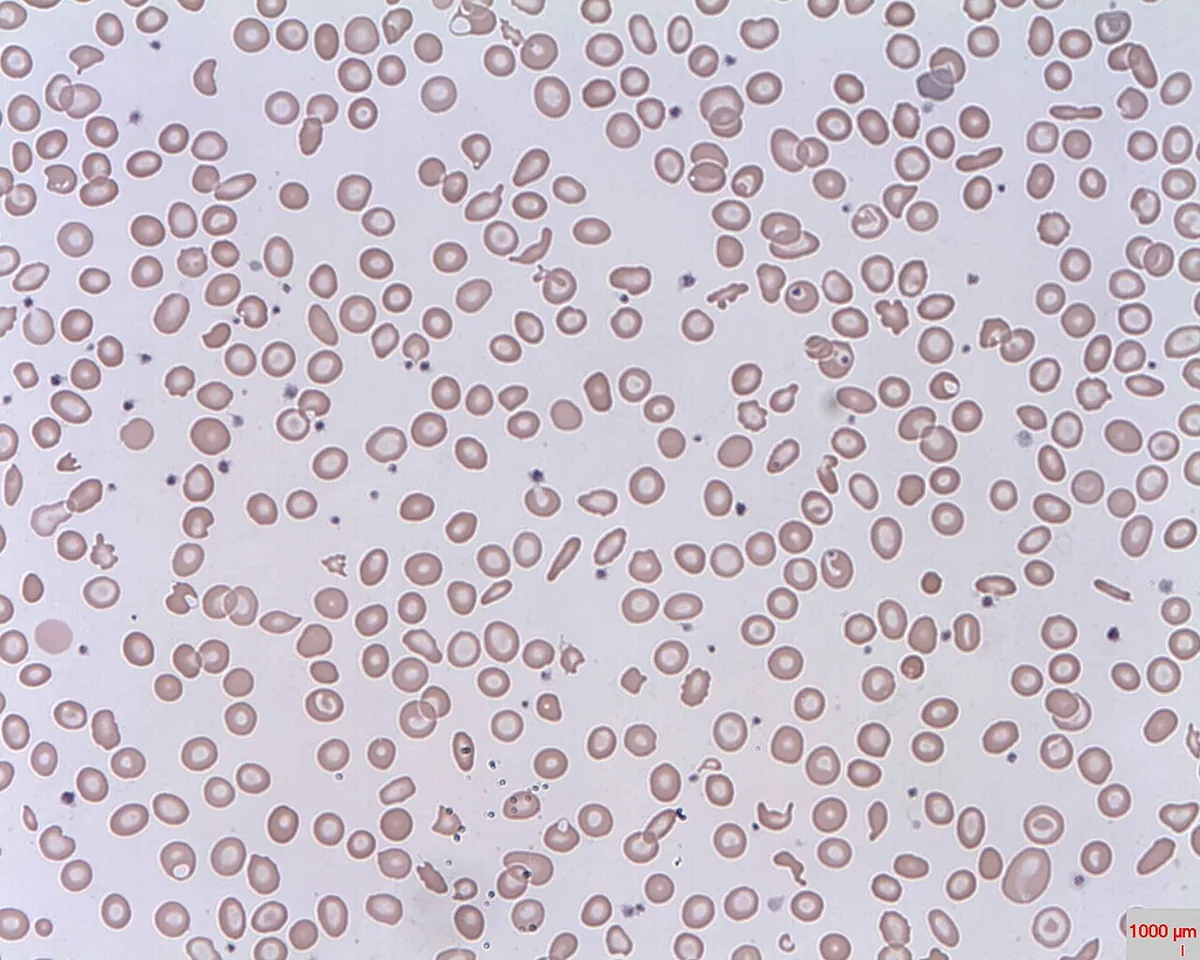 Hemolytic uremic syndrome (HUS) – Blood smear: schistocytes (helmet and triangular forms) indicating microangiopathic hemolysis