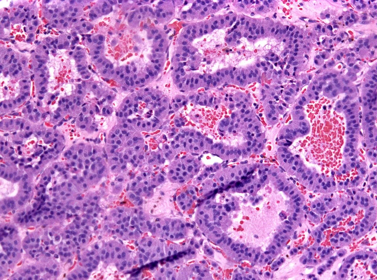 Hypopituitarism – Non-functioning pituitary adenoma (H&E): monotonous tumor cells forming pseudorosettes around vessels