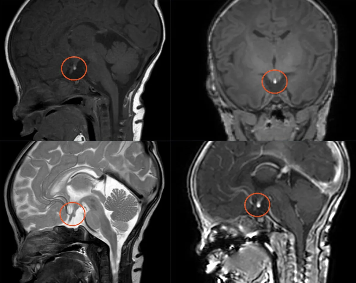 Hypopituitarism – baby – Brain MRI in congenital hypopituitarism (infant): ectopic, T1-bright neurohypophysis at the median eminence (circle) instead of within the sella