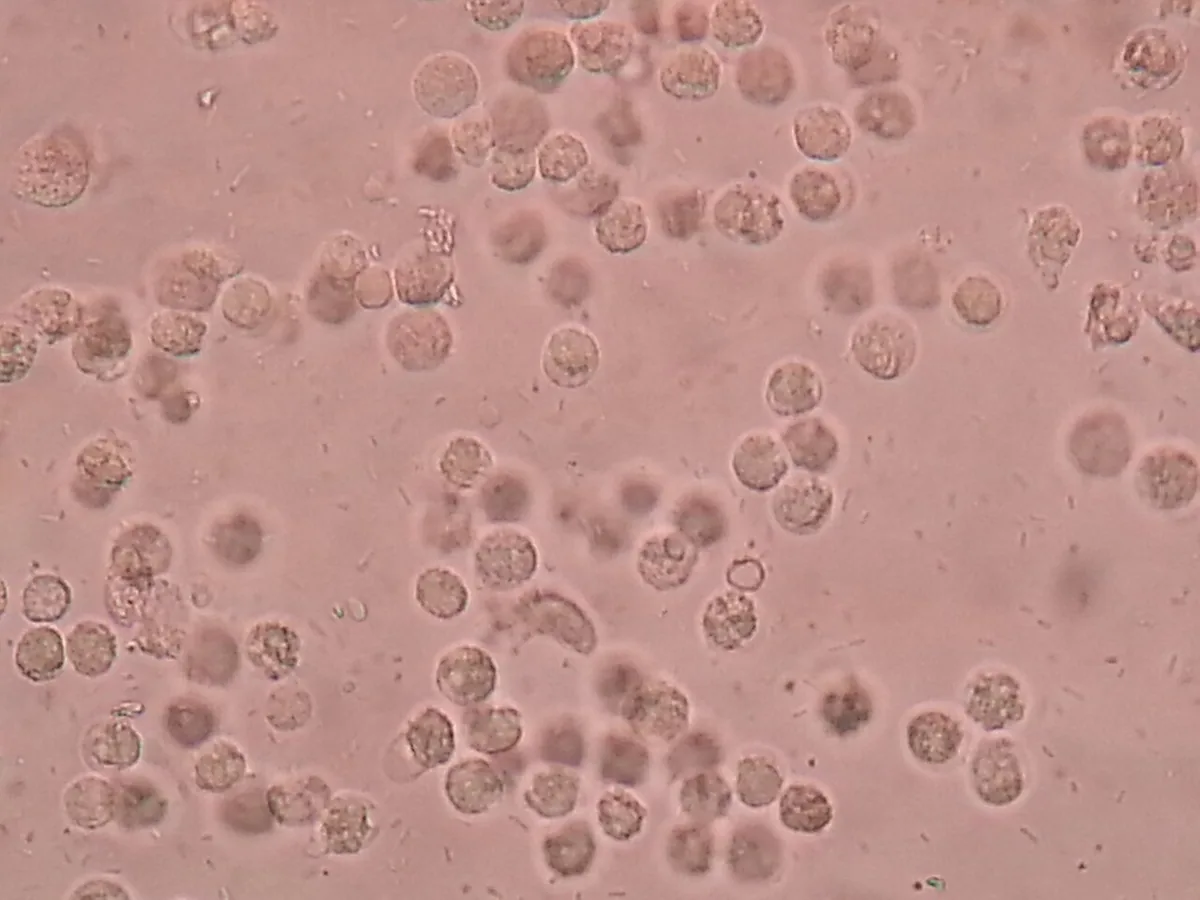 Urinary tract infection and cystitis (bladder infection) – blood smear/cytology: Urine sediment in urinary tract infection: abundant white blood cells (pus cells)