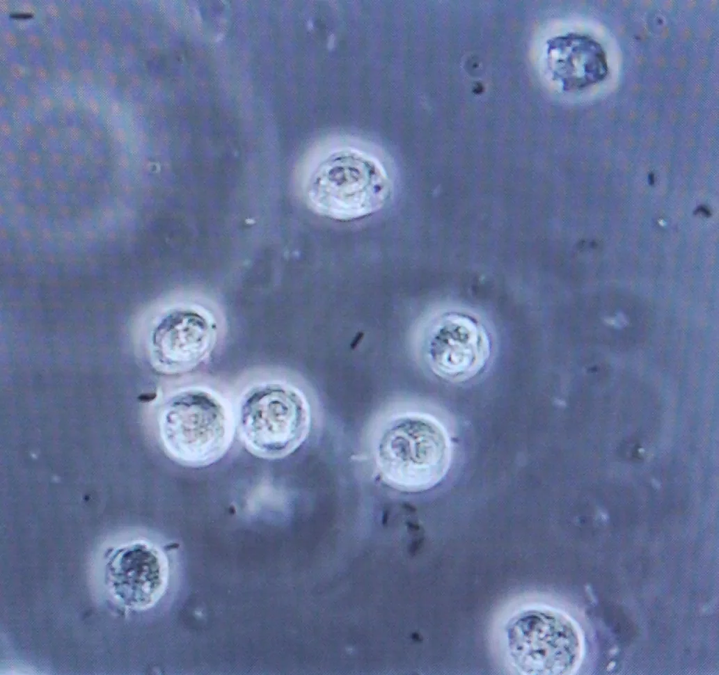 Urinary tract infection and cystitis (bladder infection) – blood smear/cytology: Urine microscopy (phase contrast): white blood cells (pyuria) and numerous rod-shaped bacteria (bacteriuria)