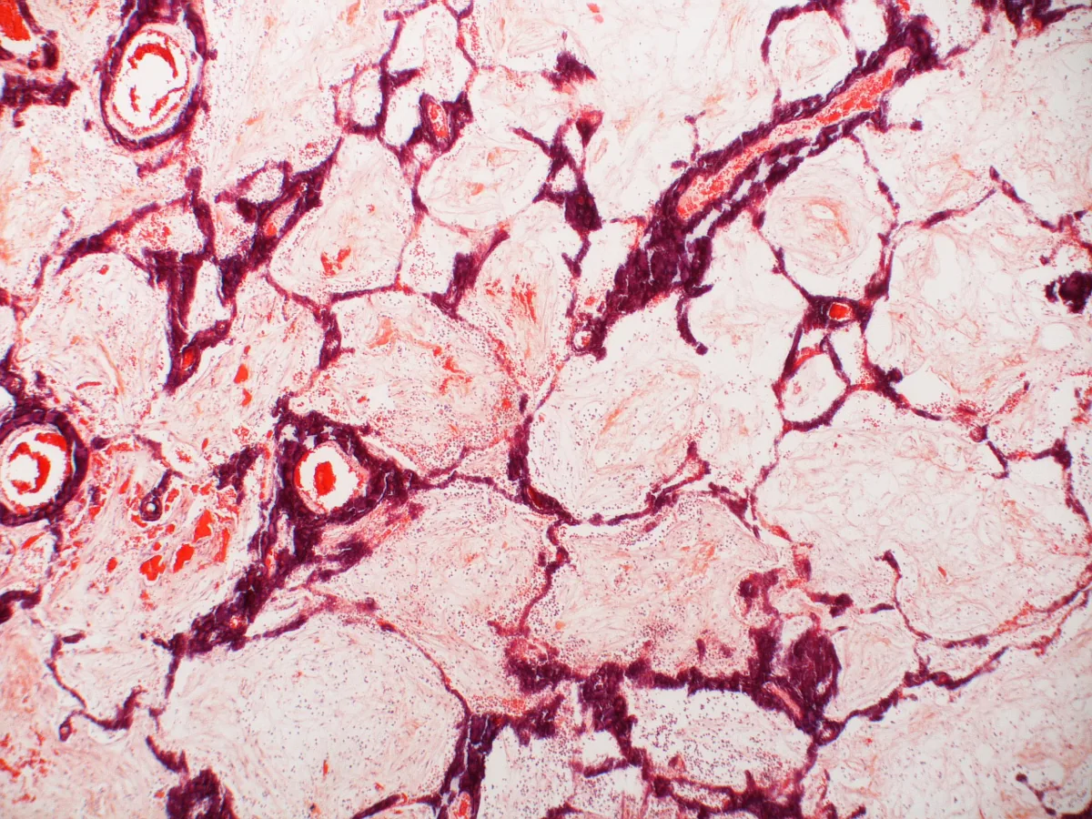 Hypercalcemia – Lung histology (H&E): dark purple calcium deposits in the alveolar walls (metastatic calcification)