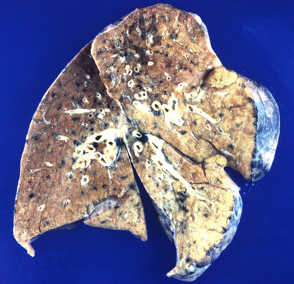 Hypercalcemia – gross specimen: Lung specimen with metastatic calcification in hypercalcemia: firm, whitish-yellow calcium deposits in the lung tissue