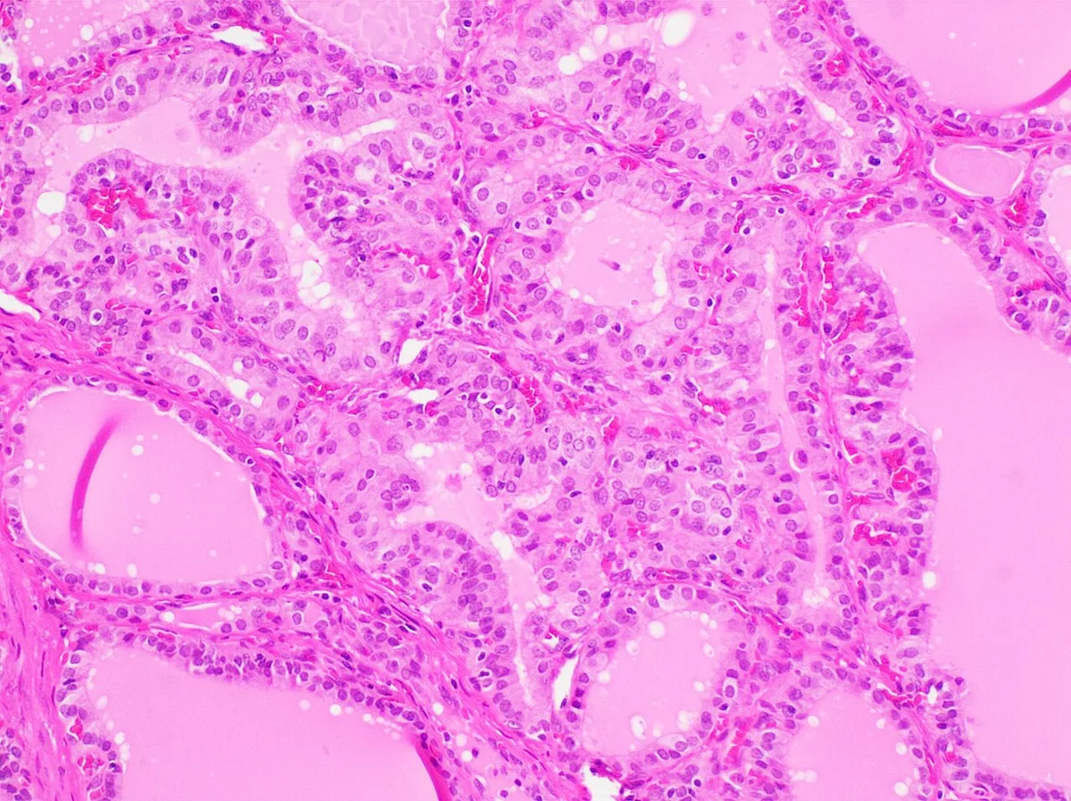 Hyperthyroidism – Histology of a hyperthyroid gland (Graves' disease, H&E): hyperplastic follicles with tall epithelium and pale, scalloped colloid