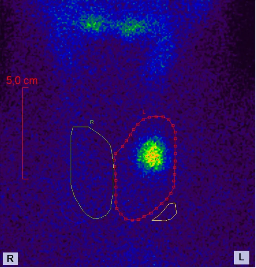 Hyperthyroidism – Thyroid scintigraphy: focal increased uptake in the left lobe (hot nodule) with largely suppressed remaining tissue