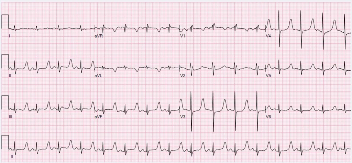 Hypocalcemia – 12-lead ECG in hypocalcemia: prolonged QT interval due to a lengthened ST segment