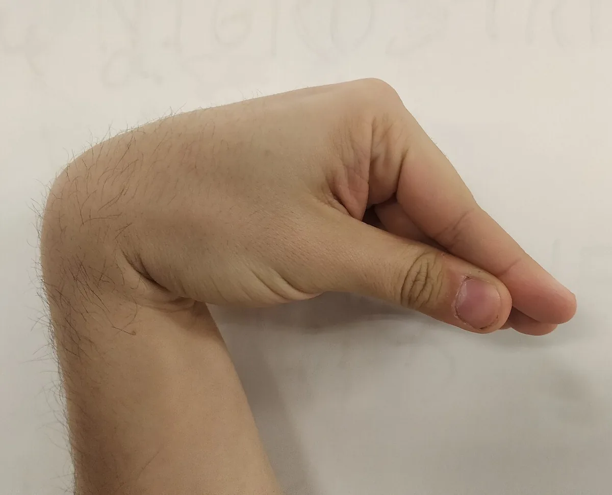 Hypocalcemia – clinical photo: Trousseau sign: carpal spasm with flexion at the wrist and metacarpophalangeal joints and extended fingers in latent tetany
