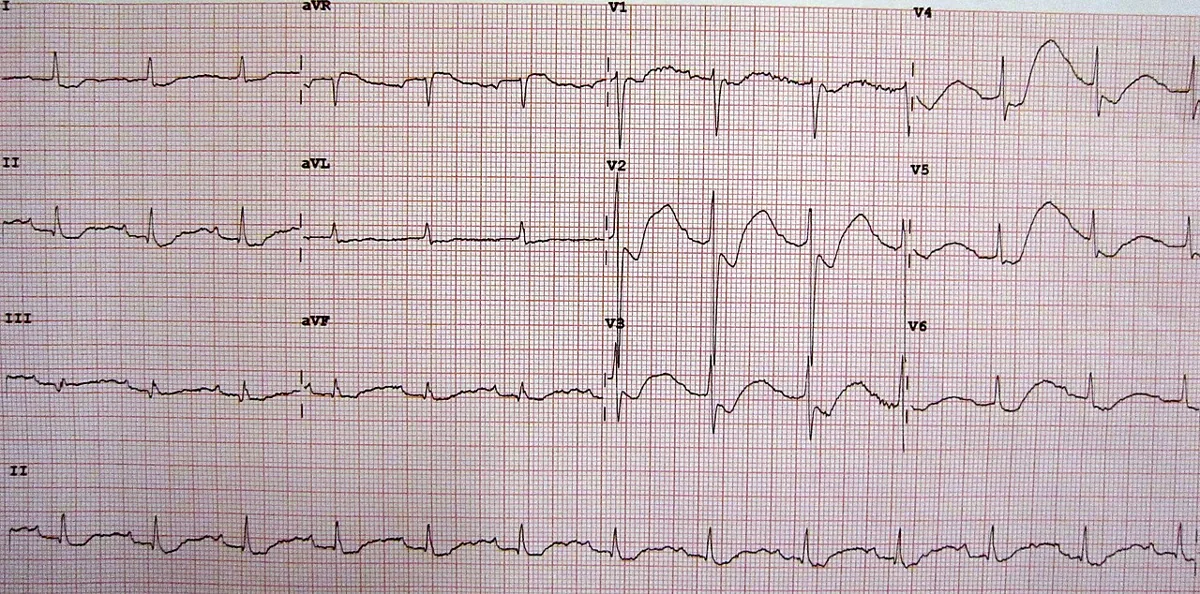 Hypokalemia – 12-lead ECG in hypokalemia: flattened T waves, ST depression and prominent U waves, especially in V2–V4