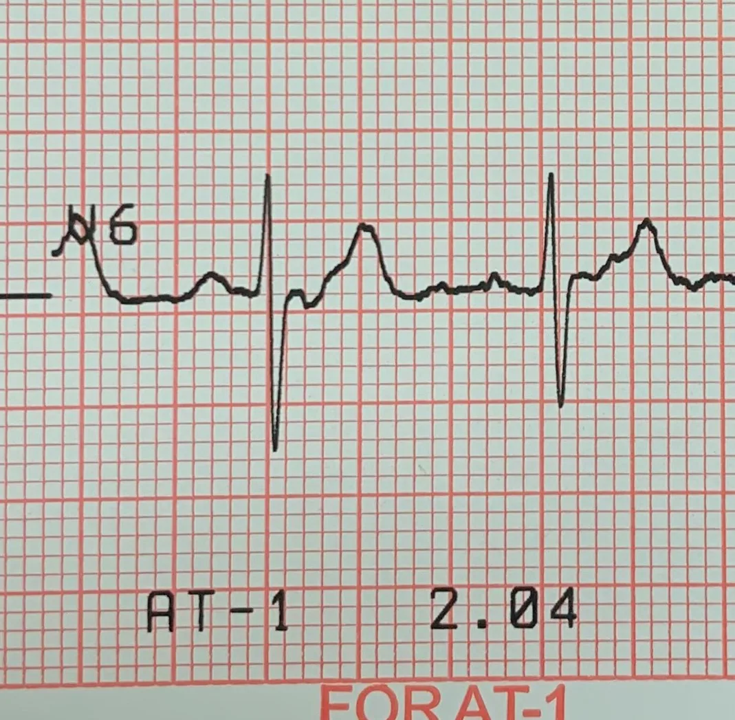 Hypokalemia – ECG detail (V6): distinct U wave right after the T wave